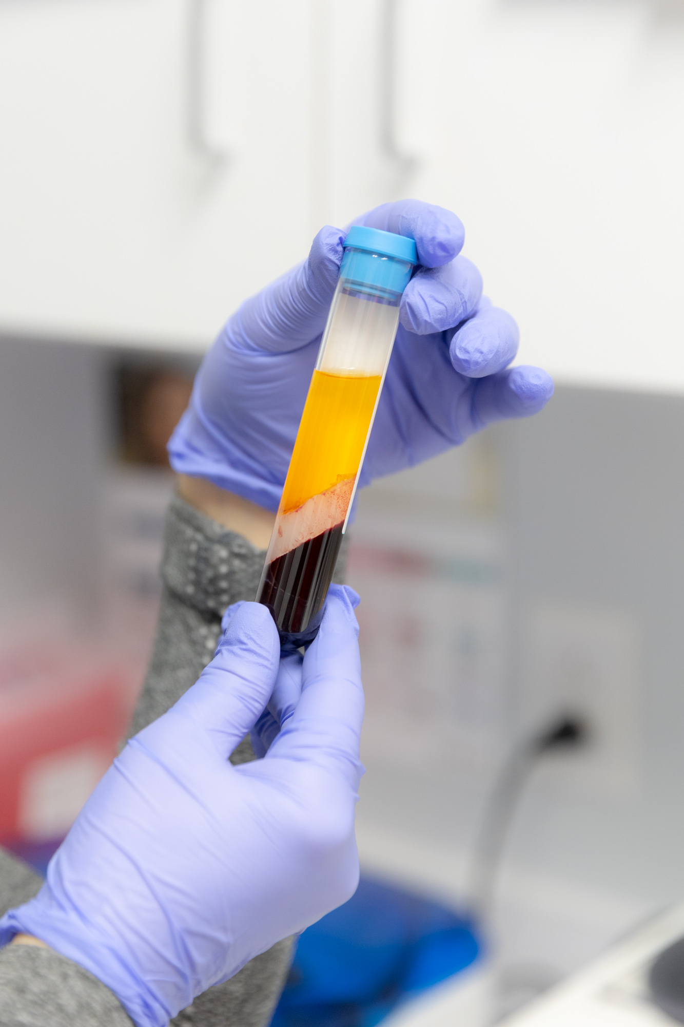 Person with purple medical gloves holds a vial ready for PRP injections near Cleveland